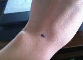 手上有痣代表什么一般来说,手腕外侧长痣手腕内侧实权