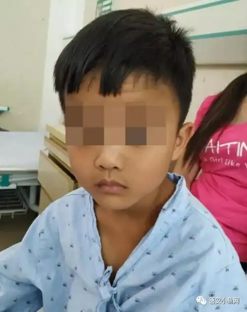 无独有偶,来自南安水头的6岁男童鑫鑫(化名)同样因眼外伤住进了该医院