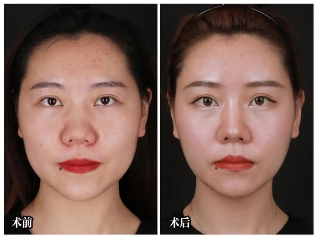 自体脂肪填充77面部吸脂案例分享