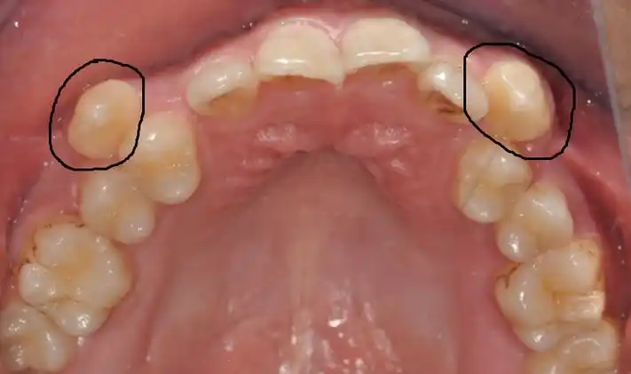 虎牙突出来拔掉就好了口腔科普第十八期