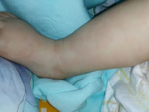 那段时间刚好吃了虾,去医院说是过敏,月子里我得了荨麻疹_百度宝宝