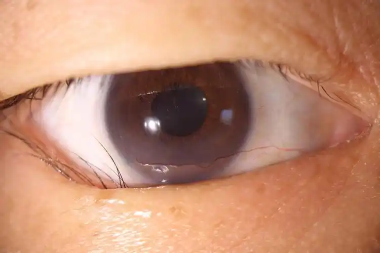 任性眼睑内翻本是护卫反戳主人多图