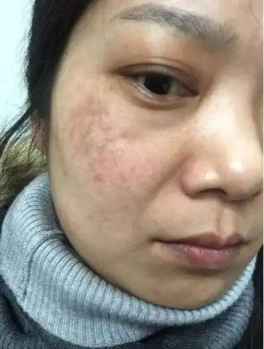 夏天容易晒黑,长斑是怎么回事?皮肤科医生:有可能是这个原因