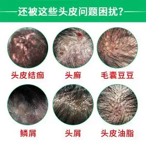 专治毛囊炎药膏