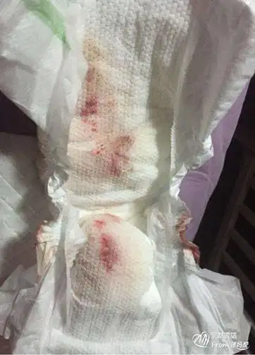 黄疸|分泌物|新生儿|巩膜_网易订阅