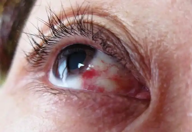 您好医生我眼睛血丝很重且感觉有层膜似_39健康网问医生wap版