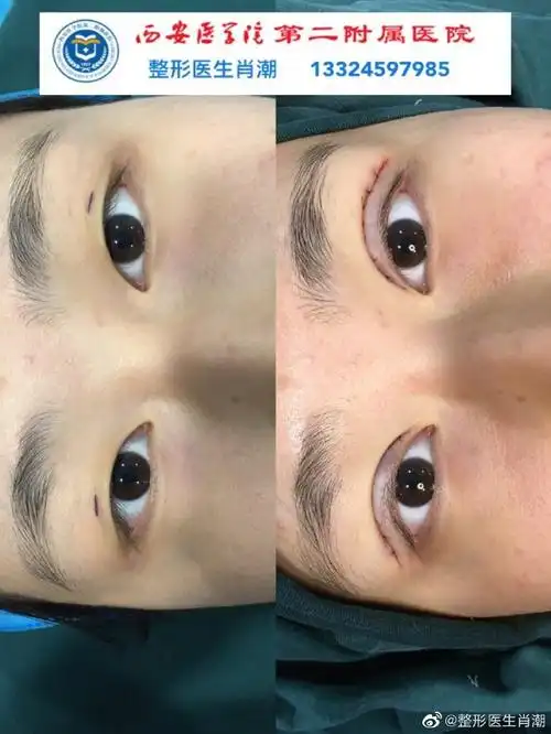 全切双眼皮手术术前术后即刻对比术前诊断. 来自整形医生肖潮 - 微博