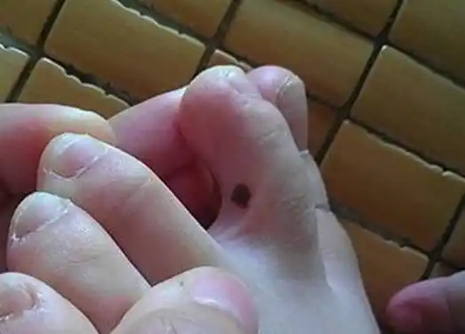 女人脚趾有痣含义脚趾缝之间有痣代表富贵