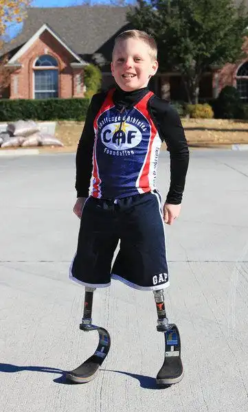 9岁截肢男孩自制20余条假肢参加短跑训练