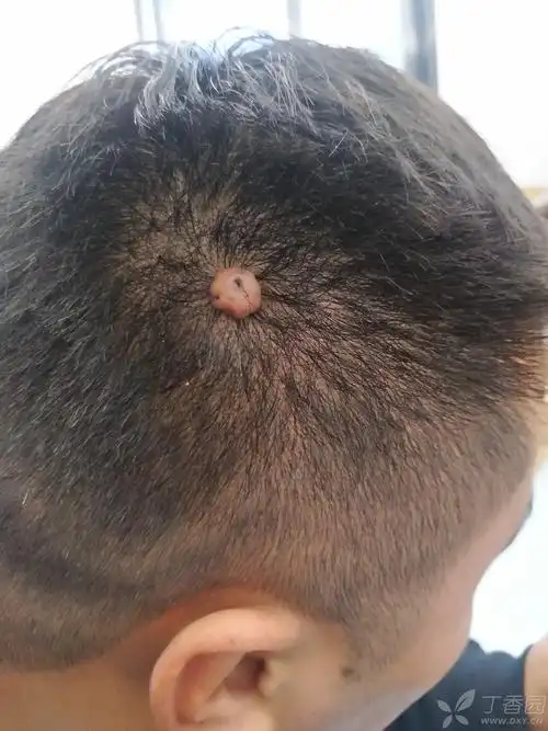 请问一下这是什么瘤子,会不会成恶性肿瘤?