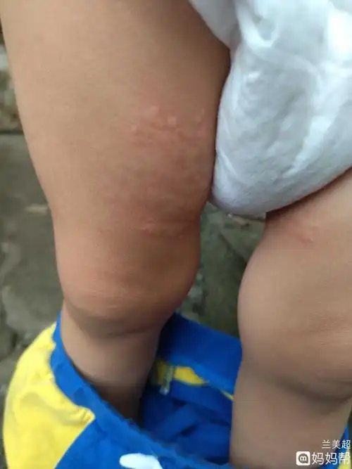 服务模式!新生儿荨麻疹症状"欢聚一堂"-第2张图片-何蜜网