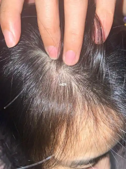 地雷滚滚用英诺头皮精华长痘痘