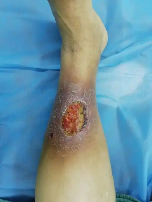 延安市中医院骨科开展了多例下肢慢性溃疡患者的手术治疗