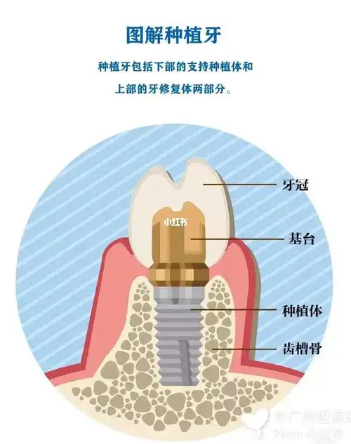 图解种植牙