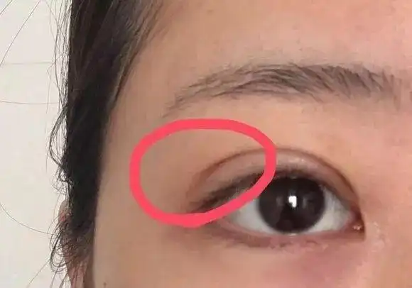 其实呀,双眼皮的形成是因为有一部分的提上睑肌可以穿至皮肤层,所以在