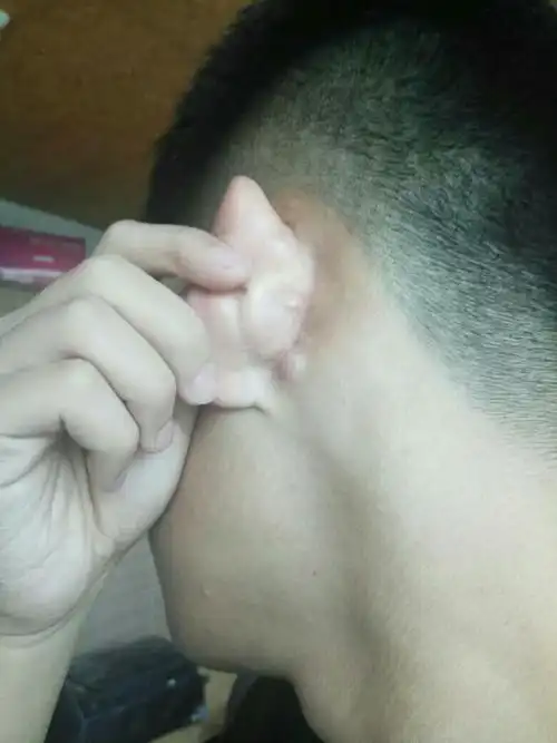 耳朵后面起一个痘痘,不痛,怎么处理呢