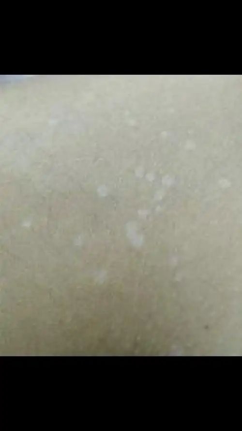 绿豆大小,不痛不痒,这个白斑就是特发性白斑或叫点状白斑,俗称老年性