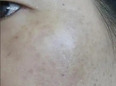 皮肤黑变病的诊断