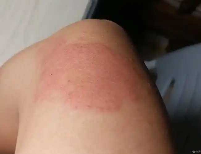 夏天皮肤总起这种红斑痒略带辣的疼