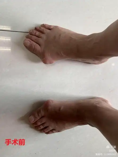 裴阿姨又能翩翩起舞了——骨科巧治"大脚骨"病