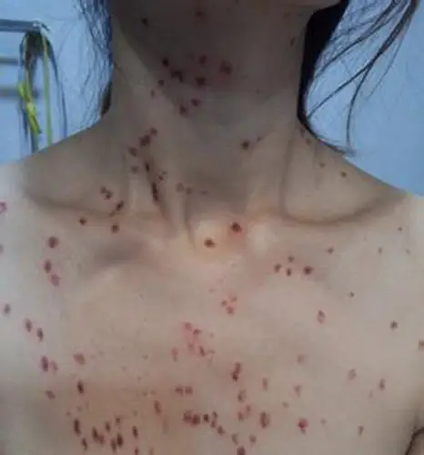 胸前大片扁平疣图片