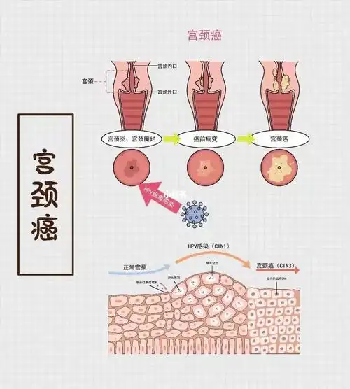 73感染hpv病毒,很容易演化成宫颈癌6015