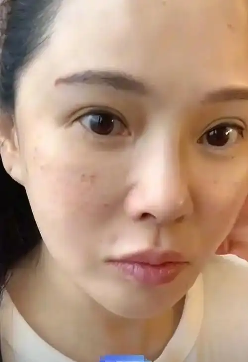 秦昊老婆跑韩国打水光针,56岁伊能静满脸针痕,感慨:真的好痛