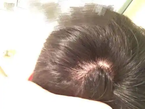 快来测测你有没有躺枪头皮敏感吧!