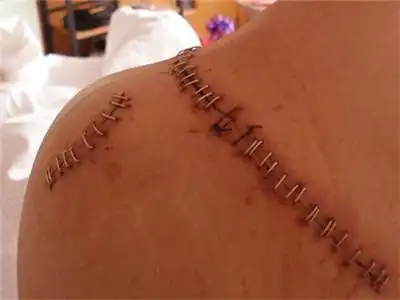 每个爱美的人都不希望自己的皮肤留下疤痕,那么刀伤怎么处理不留疤呢?