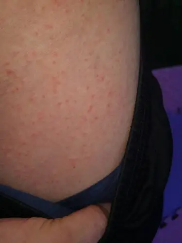 这是螨虫咬的吗?很痒的小红点