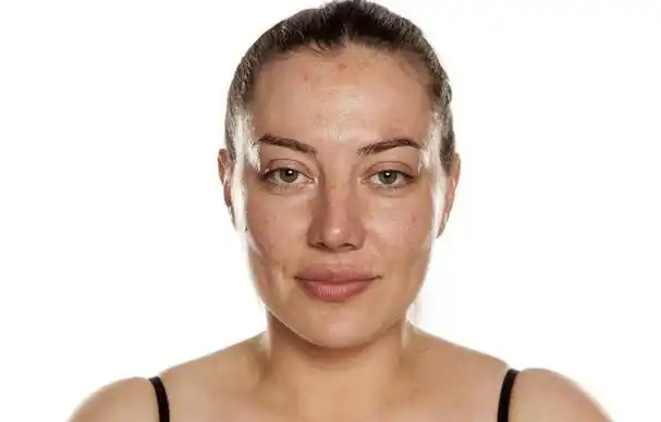 皮肤问题困扰着不同年龄段的女性皮肤暗沉,有黄气"护肤"这件事上,许多