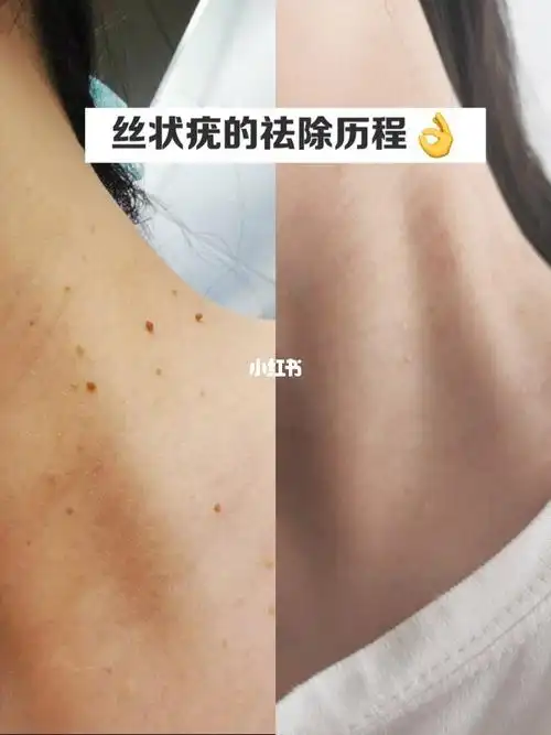 长了丝状疣别人总是有意无意的远离我