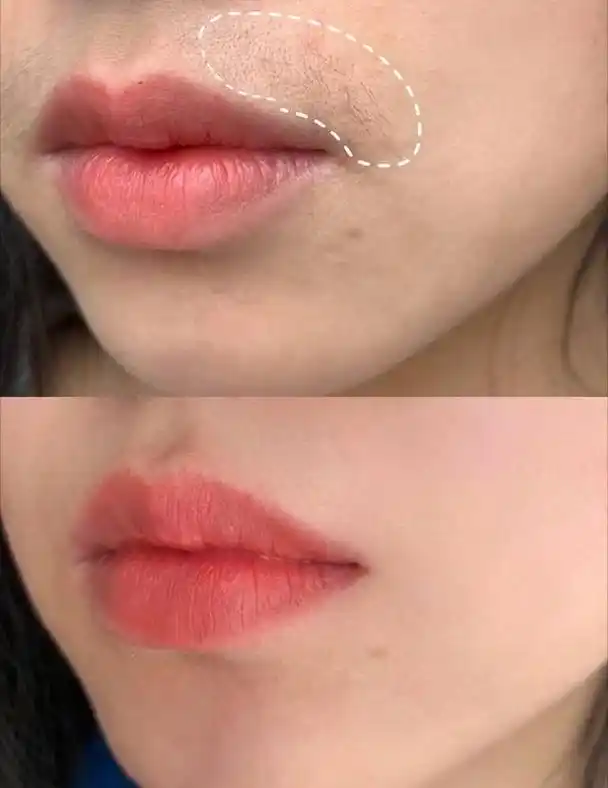 为什么有的女生唇边长小胡子唇毛的多少与什么因素有关