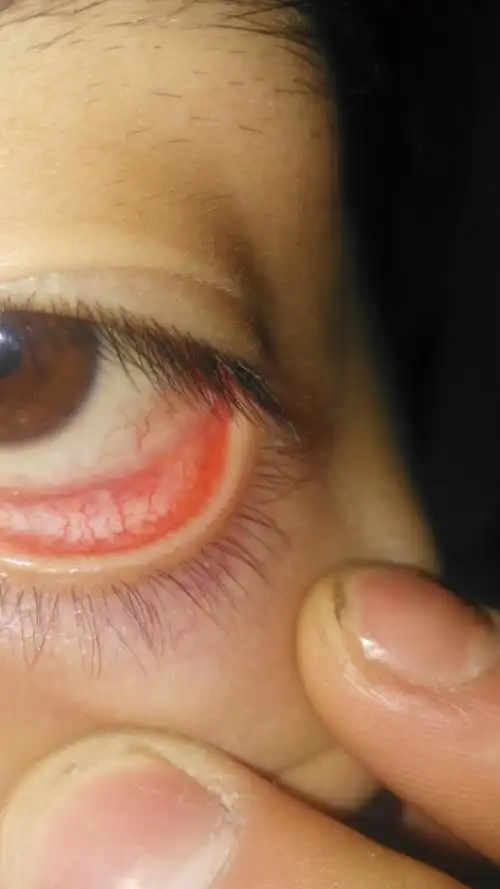 眼睛下眼皮发黄红血丝变多舌头的舌苔也发黄脸上长了很多逗逗是怎么