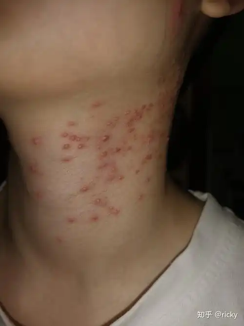 马拉色菌毛囊炎的治疗史