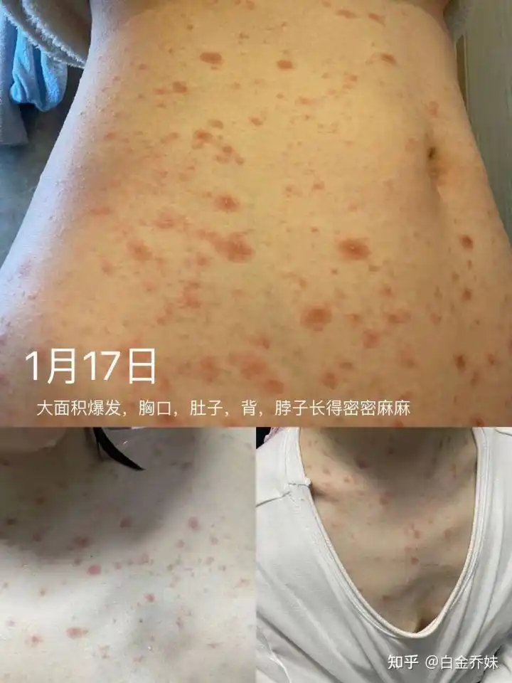 一次关于玫瑰糠疹的记录