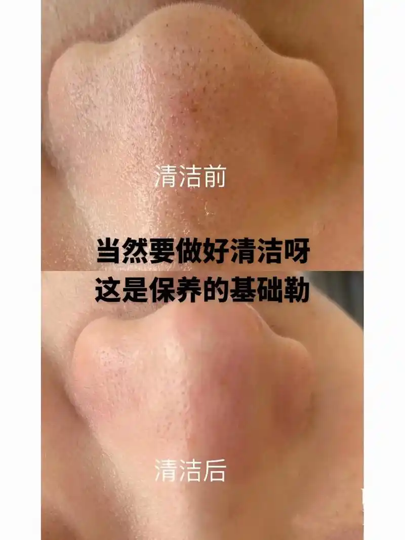 毛孔黑头清洁前后对比vs.毛孔黑头清洁前后对比vs 请不要忽 - 抖音