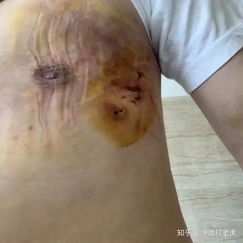 男性乳腺增生手术过程