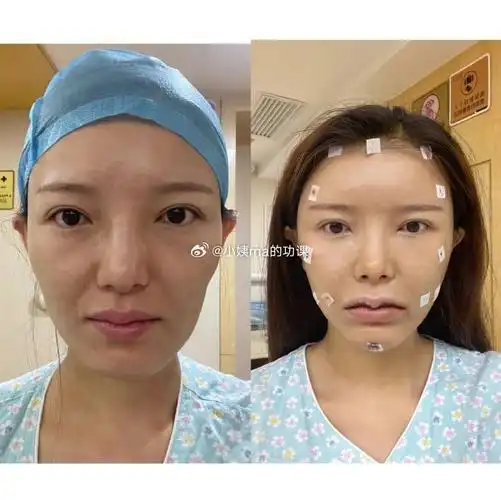 上海面部填脂肪填充##上海全脸填充##北京自体脂肪填充