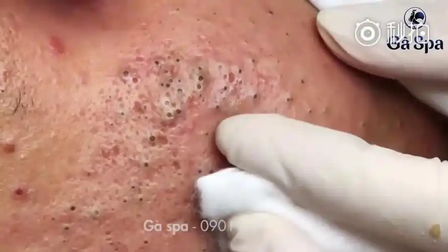 超级酸爽的挤黑头挤粉刺挤痘痘视频减压专用cr网络微博爆料