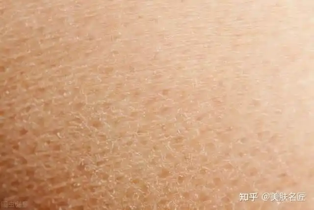 为什么肌肤会缺水我们该如何预防皮肤干燥