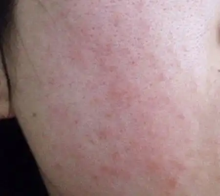 过敏症患者要十分小心护理皮肤,除了保持每天3次温水洗脸外,还要用些