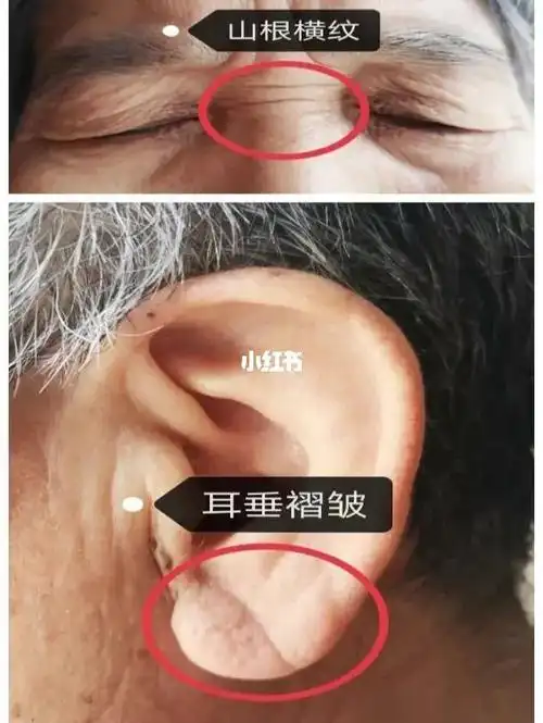 67山根位置出现横纹往往在中老年人身上最多,因为这里出现横纹代表