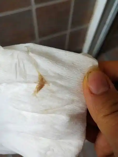 6,你好,白带中有血丝不能排除是宫颈糜烂或是排卵期出血1排卵期出血是