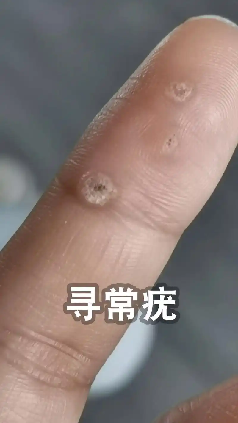 寻常疣,扁平疣,跖疣,丝状疣,尖锐湿疣. - 抖音