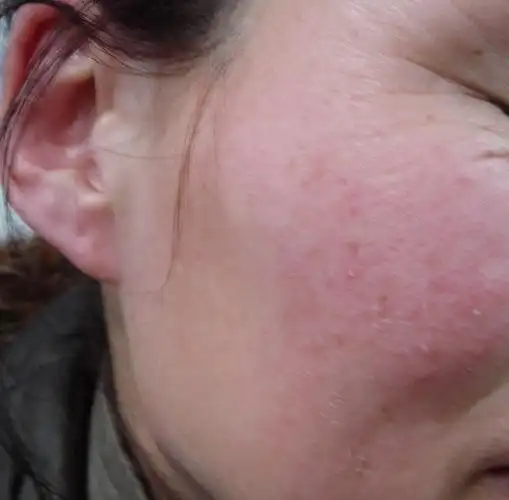 皮肤发红,痒,掉皮.是怎么回事?