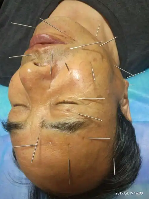 7,请看5个视频何天有老师传承中医针灸风彩之七