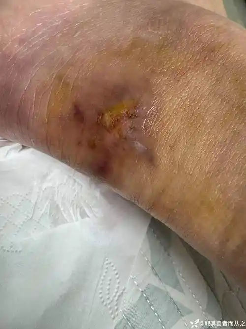 外伤皮肤坏死创面一例