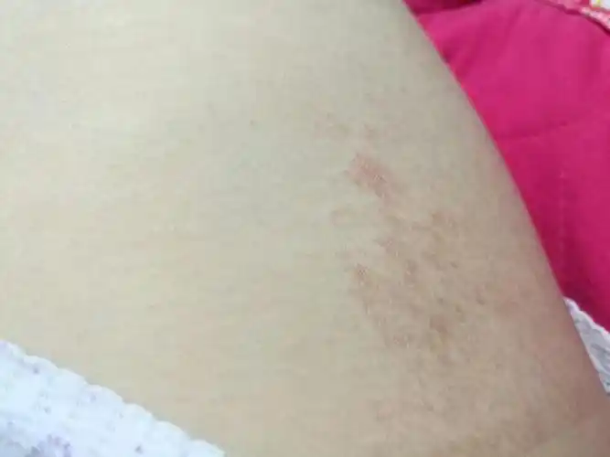 看看这是什么,大腿内侧长的,像是癣还是什么呢