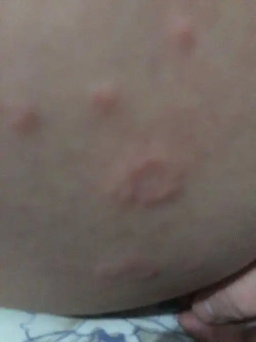 大腿根部湿疹爽身粉 大腿内侧潮湿用爽身粉